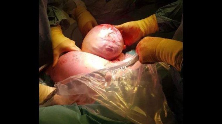 Amniyotik kesede doğan bebek: Tuhaf fakat muhteşemdi