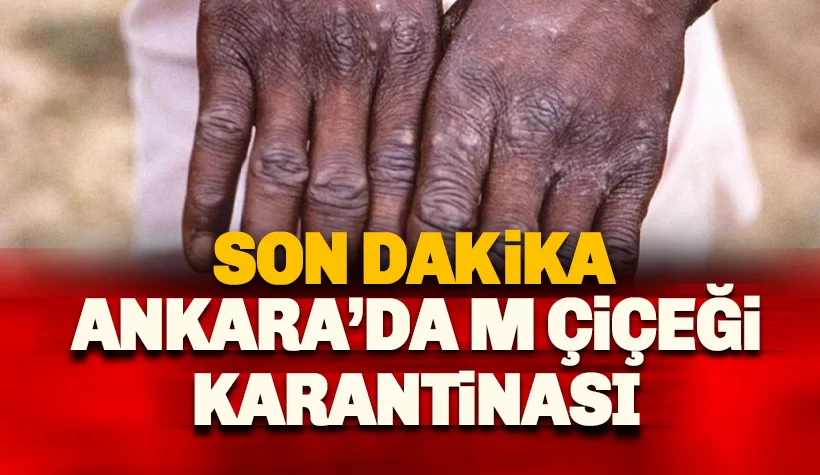 Son dakika: Türkiye'de Maymun Çiçeği şüphesi: 4 kişi karantinaya alındı